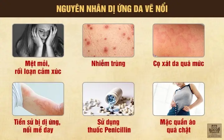 Cách Trị Bệnh Da Vẽ Nổi Cách Trị Bệnh Da Vẽ Nổi