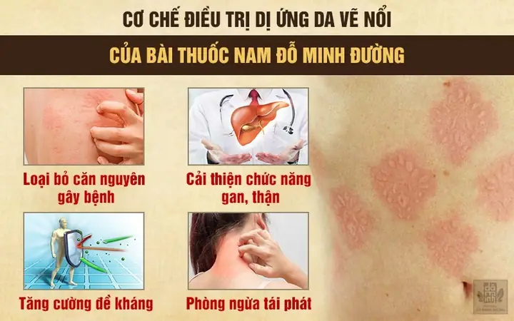 Cách Trị Bệnh Da Vẽ Nổi Cách Trị Bệnh Da Vẽ Nổi