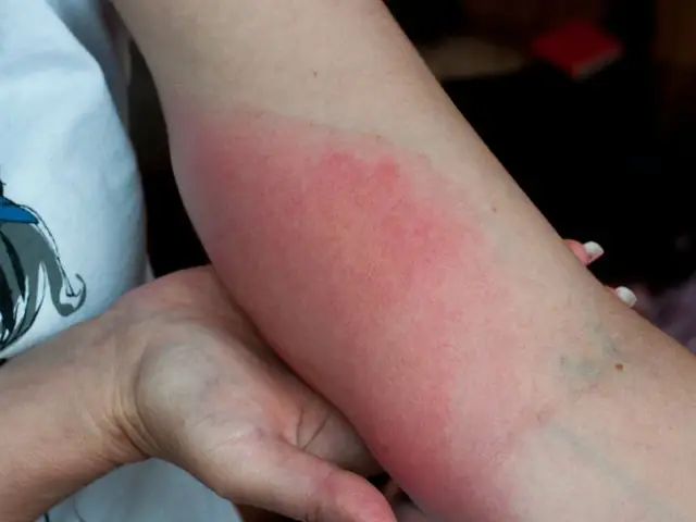 Cách Trị Ong Vò Vẽ Đốt