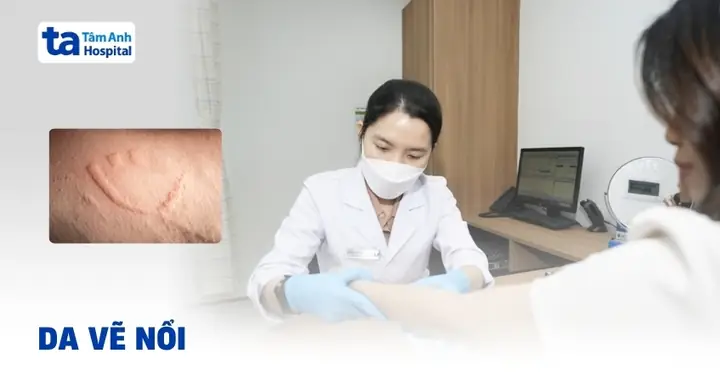 Da Vẽ Nổi Cách Điều Trị Da Vẽ Nổi Cách Điều Trị